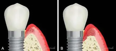 Mucosite peri-implantar - Clínica Simino