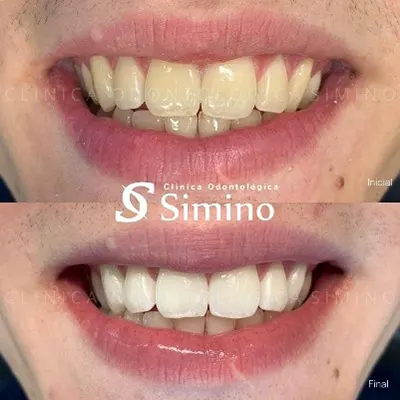 Clareamento Dentário Dr. ana Clara Ribeiro 01