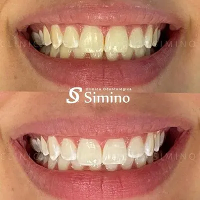Clareamento Dentário Dr. ana Clara Ribeiro 02