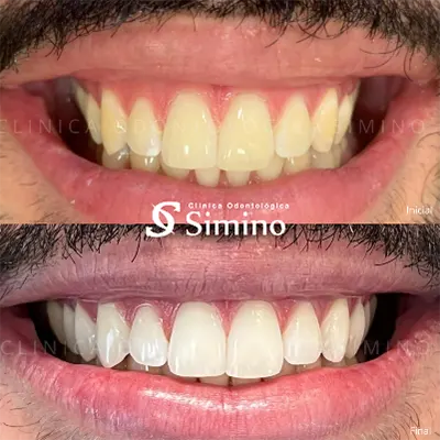 Clareamento Dentário Dr. ana Clara Ribeiro 03