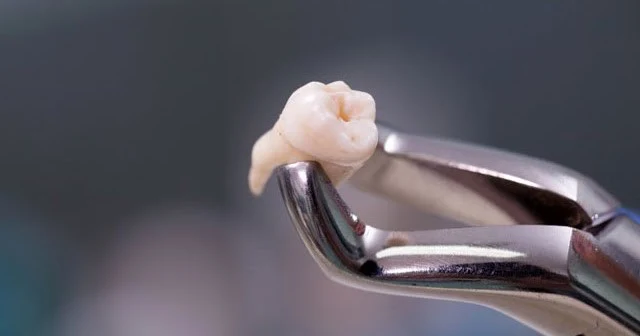 Extração Dentária - Clínica Simino