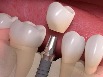 Prótese Sobre Implante Unitária - Clínica Simino